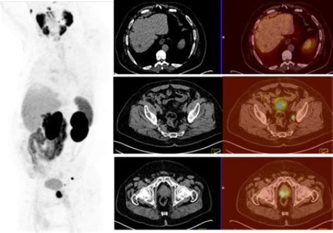 Ga Psma Pet Ct Improves Initial Staging Of High Risk Prostate Cancer Patients Applied Radiology