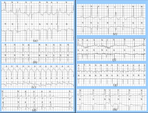 Examples Of Different Cardiac Arrhythmias With Correct A D And
