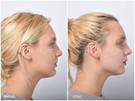 The Easiest Way To Get Rid Of Turkey Neck Without Surgery Belcourt