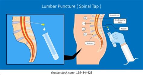 341 Lumbar Puncture Images Stock Photos And Vectors Shutterstock