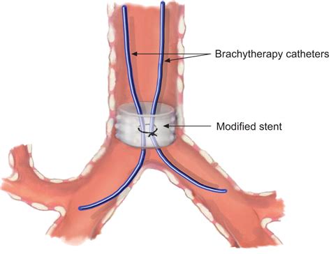 Optimisation Of Bronchial Brachytherapy Catheter Placement With A