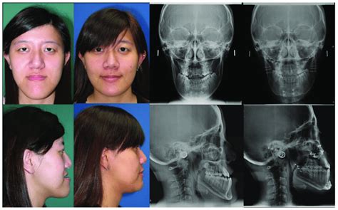 Case Of An 18 Year Old Woman With A Facial Deformity Characterized By A Download Scientific