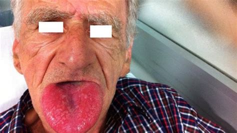 Angioedema Causes Symptoms Treatment Diagnosis Hereditary Angioedema Angiodema Vs