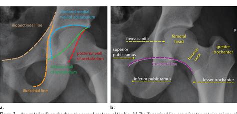 Posterior Dislocation Of Hip Semantic Scholar