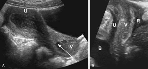 Gynecologic Sonography In The Pediatric And Adolescent Patient