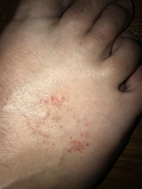 What Causes A Rash On My Feet