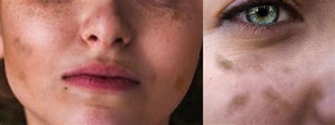 Women With Facial Light Or Dark Spots Discoloration Or Uneven Skin