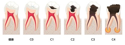 Progression Of Tooth Decaypng 多摩市永山 亀山歯科