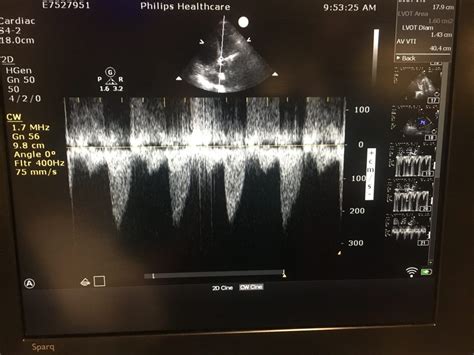 Quick Calculation Of Aortic Stenosis With Bedside Ultrasound Loma