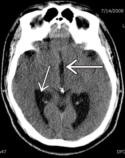 Non Communicating Hydrocephalus The Western Journal Of Emergency Medicine