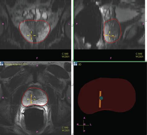 介入泌尿外科 成功进行前列腺融合活检的技巧 活检 融合 MRI TRUS 平台 健康界