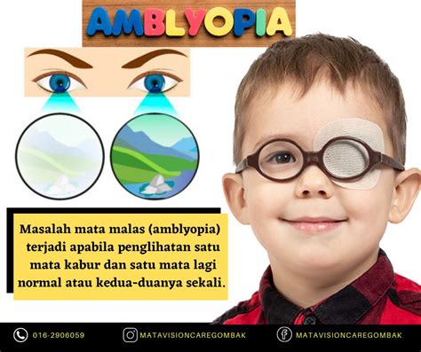Amblyopia Mata Malas