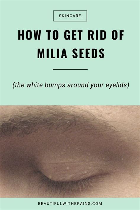 How To Prevent And Treat Milia Seeds Beautiful With Brains