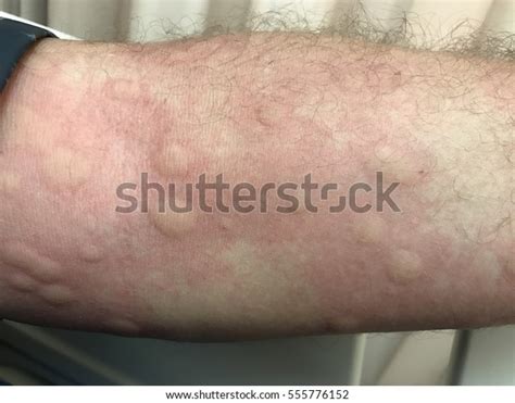Urticarial Rash Drug Allergy Stock Photo Edit Now 555776152
