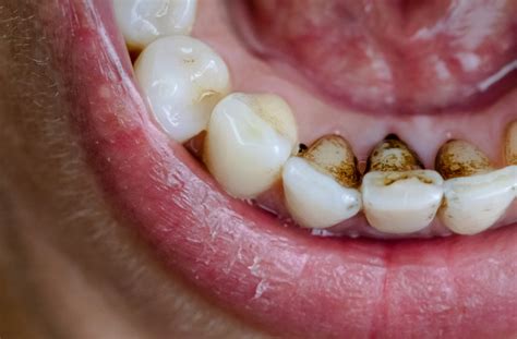 What To Do About Black Teeth Stains Melbourne Dental House