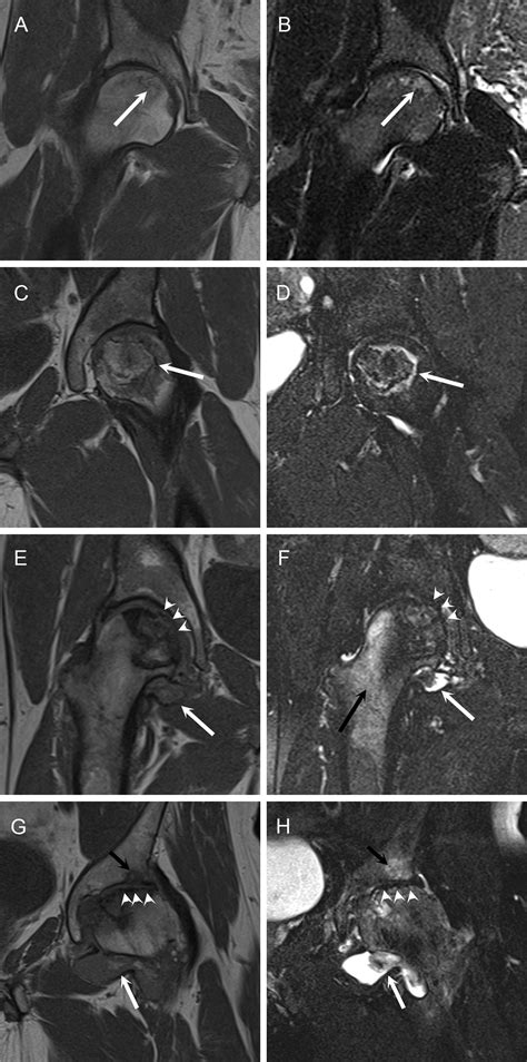 Magnetic Resonance Imaging Of Avascular Necrosis Of The Femoral Head