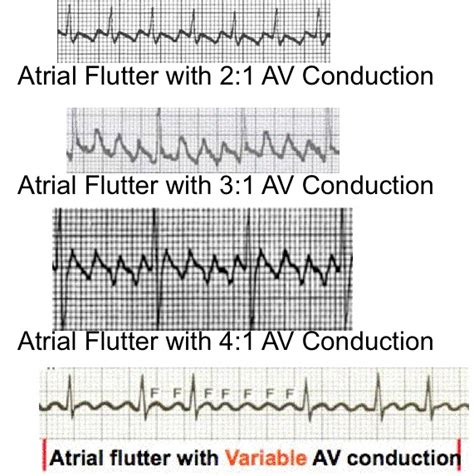 Atrial Flutter Vs Atrial Fibrillation