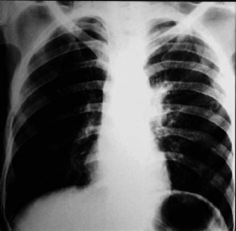 Frontal Chest Radiograph Showing Poorly Defined Nodules In The Left