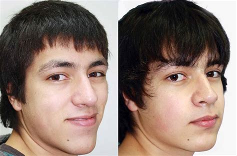 Face Nose Bite And Chin Asymmetry Correction Orthognathic Surgery