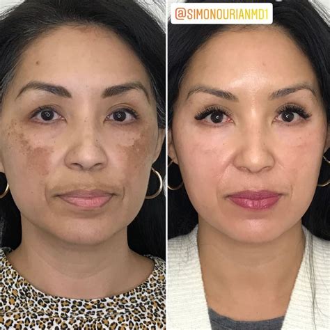 Melasma Treatment Before And After Photo Gallery Epione