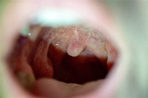 Sore Throat With Throat Swollen Closeup Open Mouth With Posterior