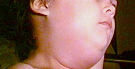 Child With Lymphedema Of The Neck And Parotid Glands Page 2 Of 2