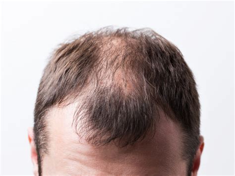 The Different Types Of Hair Loss A Simple Guide Suntrics