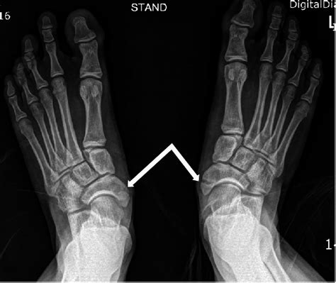 Simple Radiograph Revealed The Accessory Navicular Bone White Arrows
