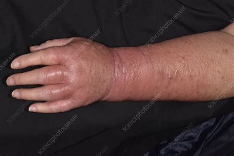 Cellulitis Stock Image C0498177 Science Photo Library