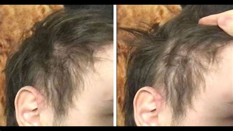 Retrograde Alopecia Dupa Is It Possible Regrow With Treatment Youtube