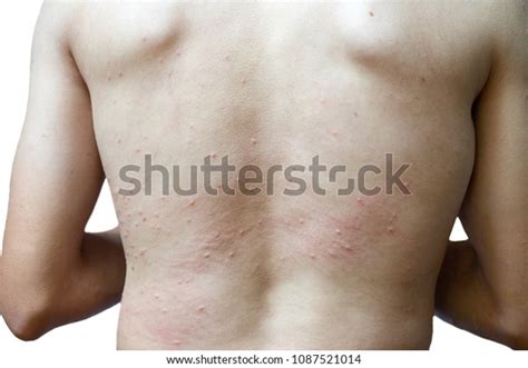 Skin Rash On Back Itchy SymptomsẢnh Có Sẵn1087521014 Shutterstock