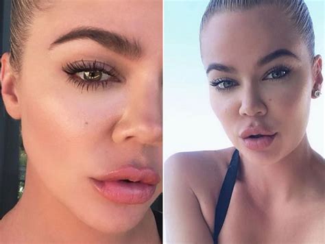 khloe kardashian has bloated lips now has she got new lip fillers in married biography