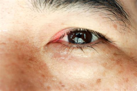 Closeup Swollen Eyes Or Blepharitis Eyes Of Asian Man Medicine And