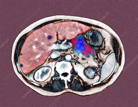 Metastatic Pancreatic Cancer Ct Scan Stock Image M1340537