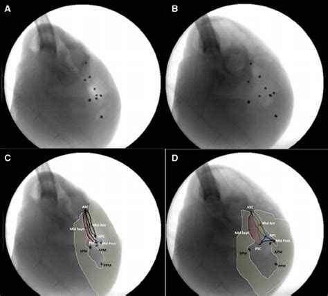 Fluoroscopic Images Of Tricuspid Valve After Valve Cinching At Baseline