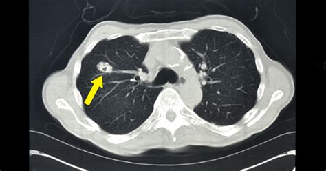 Signs Of Lung Cancer