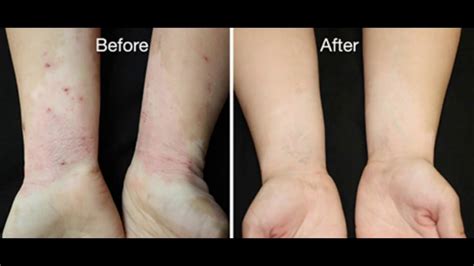 Skin Care Eczema Natural Ayurvedic Home Remedies Youtube
