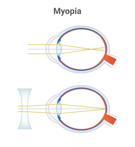 Is Myopia A Disease Review Of Myopia Management