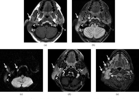 Figure 1 From Head And Neck Mri Of Kimura Disease Semantic Scholar