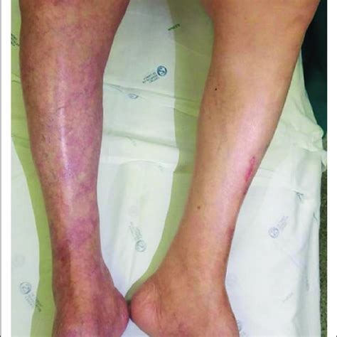 Clinical Categories Of Acute Limb Ischaemia According To Rutherford 2