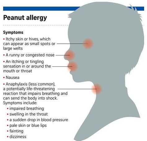 Pin On Allergies Causes Triggers Symptoms And Prevention Tips