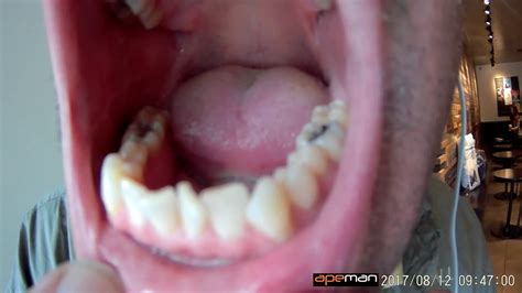 My Adjusted Incisors So It Cuts Into My Lingual Frenulum During Oral Sex With Women Youtube