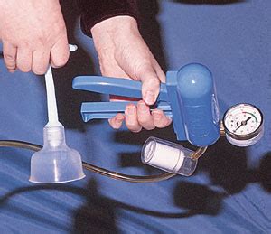 Assisted Vaginal Delivery Using The Vacuum Extractor Aafp