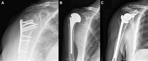 Acute Surgical Management Of Proximal Humerus Fractures Orif Vs My