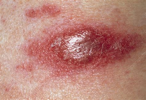 Cancerous Red Skin Lesion Due To T Cell Lymphoma Stock Image M