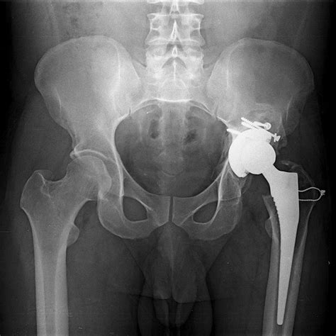 Pdf Uncemented Total Hip Replacement After Two Years Of Neglected Hip