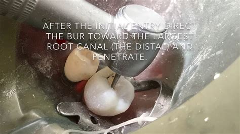 Access Cavity Of Lower First Molar Youtube