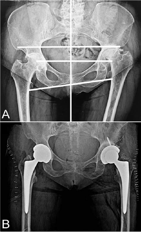 A Anteroposterior Pelvic Radiograph Of The Pre Where Bilateral Wear Of