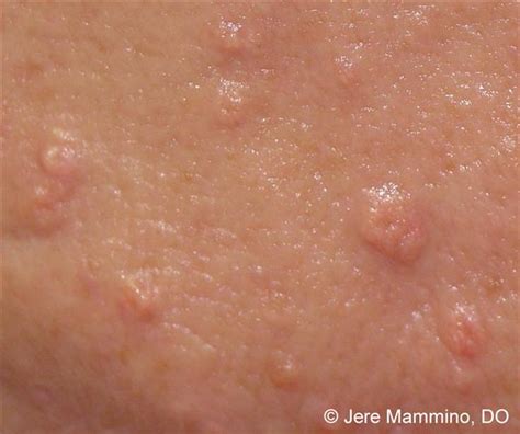 Skin Conditions That Look Like Acne But Arent