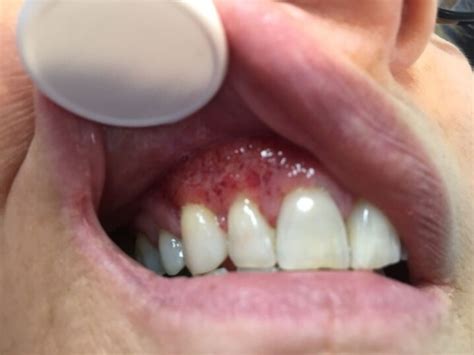 Granulomatosis With Polyangiitis Potentially Lethal Gingival Lesions
